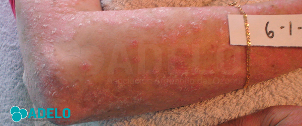 tratamiento para psoriasis